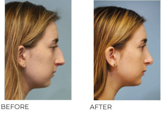 18-24 Year Old Woman Treated With Rhinoplasty 1 Year Post-Op