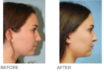 18-24 Year Old Woman Treated With Rhinoplasty 1 Year Post-Op