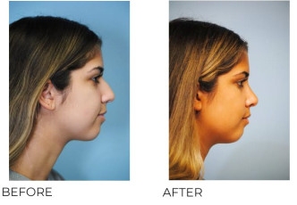 18-24 Year Old Woman Treated With Rhinoplasty 9 Months Post-Op