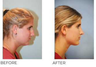 18-24 Year Old Woman Treated With Rhinoplasty 4 Years Post-Op