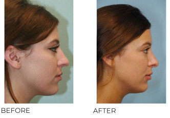 18-24 Year Old Woman Treated with Rhinoplasty 1 Year Post-Op