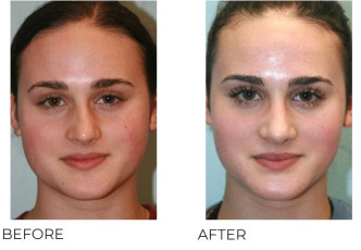 18-24 Year Old Woman Treated with Rhinoplasty 1 Year Post-Op