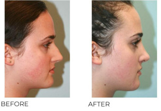 18-24 Year Old Woman Treated with Rhinoplasty 1 Year Post-Op