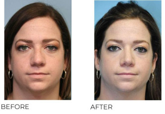 25-34 Year Old Woman Treated With Rhinoplasty 6 Months Post-Op