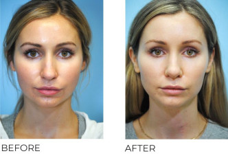25-34 Year Old Woman Treated with Rhinoplasty 1 Year Post-Op