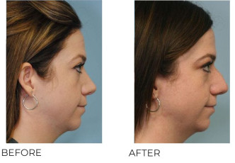 25-34 Year Old Woman Treated With Rhinoplasty 6 Months Post-Op