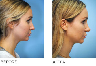 25-34 Year Old Woman Treated with Rhinoplasty 1 Year Post-Op