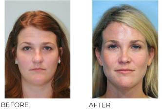 25-34 Year Old Woman Treated with Rhinoplasty 5 Years Post-Op