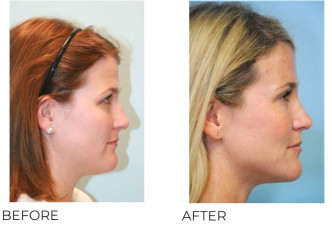 25-34 Year Old Woman Treated with Rhinoplasty 5 Years Post-Op