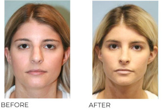 25-34 Year Old Woman Treated with Rhinoplasty 1 Year Post-Op