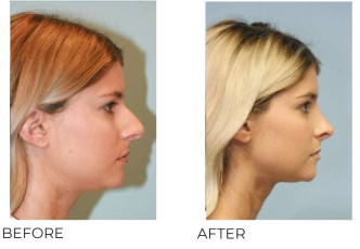 25-34 Year Old Woman Treated with Rhinoplasty 1 Year Post-Op