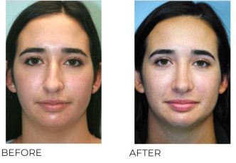 25-34 Year Old Woman Treated with Rhinoplasty 1 Year Post-Op