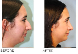 25-34 Year Old Woman Treated with Rhinoplasty 1 Year Post-Op