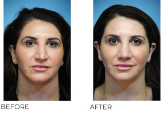 35-44 Year Old Woman Treated With Rhinoplasty 3 Months Post-Op