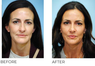 35-44 Year Old Woman Treated With Rhinoplasty 10 Months Post-Op