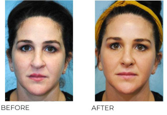 35-44 Year Old Woman Treated with Rhinoplasty 2 Months Post-Op