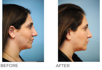 35-44 Year Old Woman Treated With Rhinoplasty 3 Months Post-Op