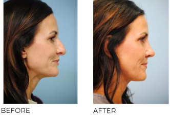 35-44 Year Old Woman Treated With Rhinoplasty 10 Months Post-Op