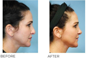 35-44 Year Old Woman Treated with Rhinoplasty 2 Months Post-Op