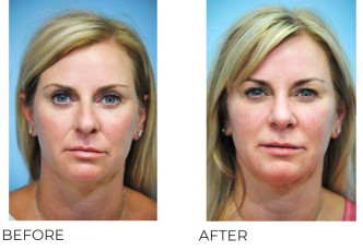 45-54 Year Old Woman Treated With Rhinoplasty 1 Year Post-Op