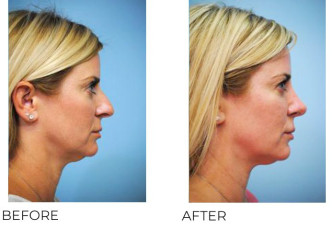 45-54 Year Old Woman Treated With Rhinoplasty 1 Year Post-Op