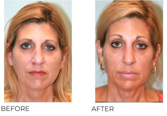 45-54 Year Old Woman Treated with Rhinoplasty and Chin Implant 1 Year Post-Op