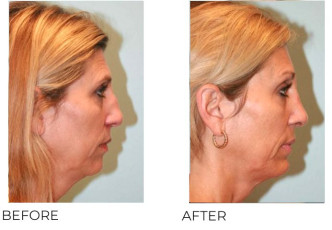 45-54 Year Old Woman Treated with Rhinoplasty and Chin Implant 1 Year Post-Op