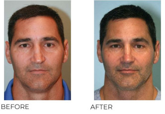 45-54 Year Old Man Treated with Rhinoplasty 1 year Post-Op