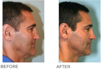 45-54 Year Old Man Treated with Rhinoplasty 1 year Post-Op