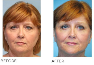 55-64 Year Old Woman Treated With Facelift 4 Months Post-Op