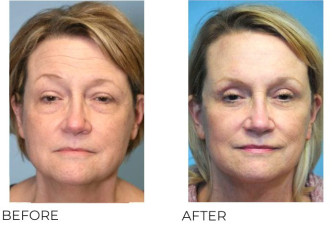 55-64 Year Old Woman Treated With Facelift 6 Months Post-Op