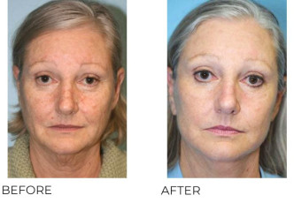 55-64 Year Old Woman Treated with Facelift Surgery 9 Months Post-Op