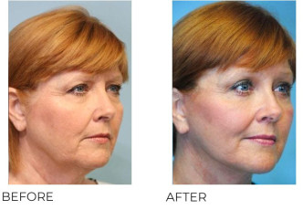 55-64 Year Old Woman Treated With Facelift 4 Months Post-Op