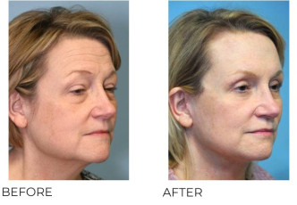 55-64 Year Old Woman Treated With Facelift 6 Months Post-Op