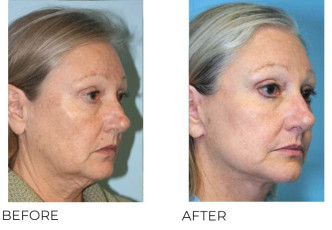 55-64 Year Old Woman Treated with Facelift Surgery 9 Months Post-Op