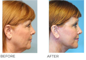 55-64 Year Old Woman Treated With Facelift 4 Months Post-Op