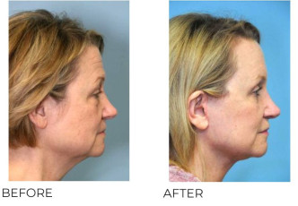55-64 Year Old Woman Treated With Facelift 6 Months Post-Op