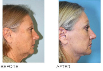 55-64 Year Old Woman Treated with Facelift Surgery 9 Months Post-Op