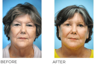 65-74 Year Old Woman treated with Facelift 3 Months Post-Op