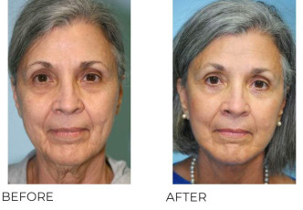 65-74 Year Old Woman Treated with Facelift and Blepharoplasty 6 Months Post-Op
