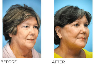 65-74 Year Old Woman treated with Facelift 3 Months Post-Op