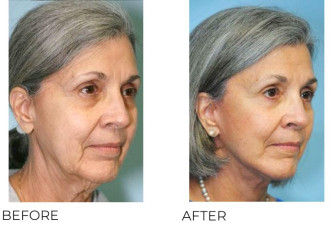 65-74 Year Old Woman Treated with Facelift and Blepharoplasty 6 Months Post-Op