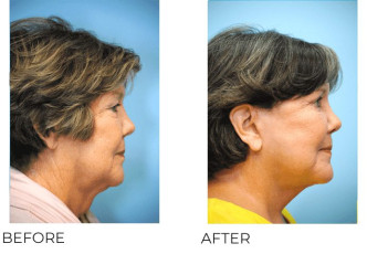 65-74 Year Old Woman treated with Facelift 3 Months Post-Op