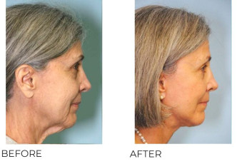 65-74 Year Old Woman Treated with Facelift and Blepharoplasty 6 Months Post-Op