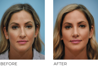 35-44 Year Old Woman Treated with Rhinoplasty 2 Months Post-Op