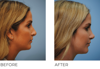 35-44 Year Old Woman Treated with Rhinoplasty 2 Months Post-Op