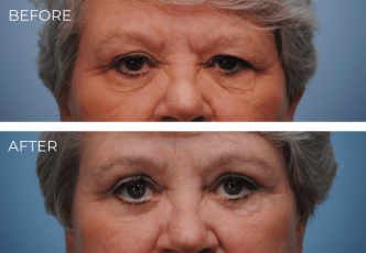 65-74 Year Old Woman Treated with Eyelid Surgery 2 Months Post-Op