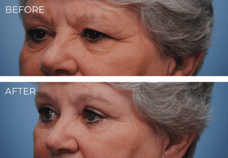 65-74 Year Old Woman Treated with Eyelid Surgery 2 Months Post-Op