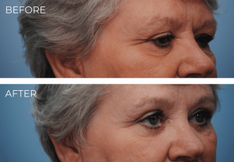 65-74 Year Old Woman Treated with Eyelid Surgery 2 Months Post-Op