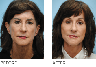 65-74 Year Old Woman Treated with Facelift 1 Month Post-Op